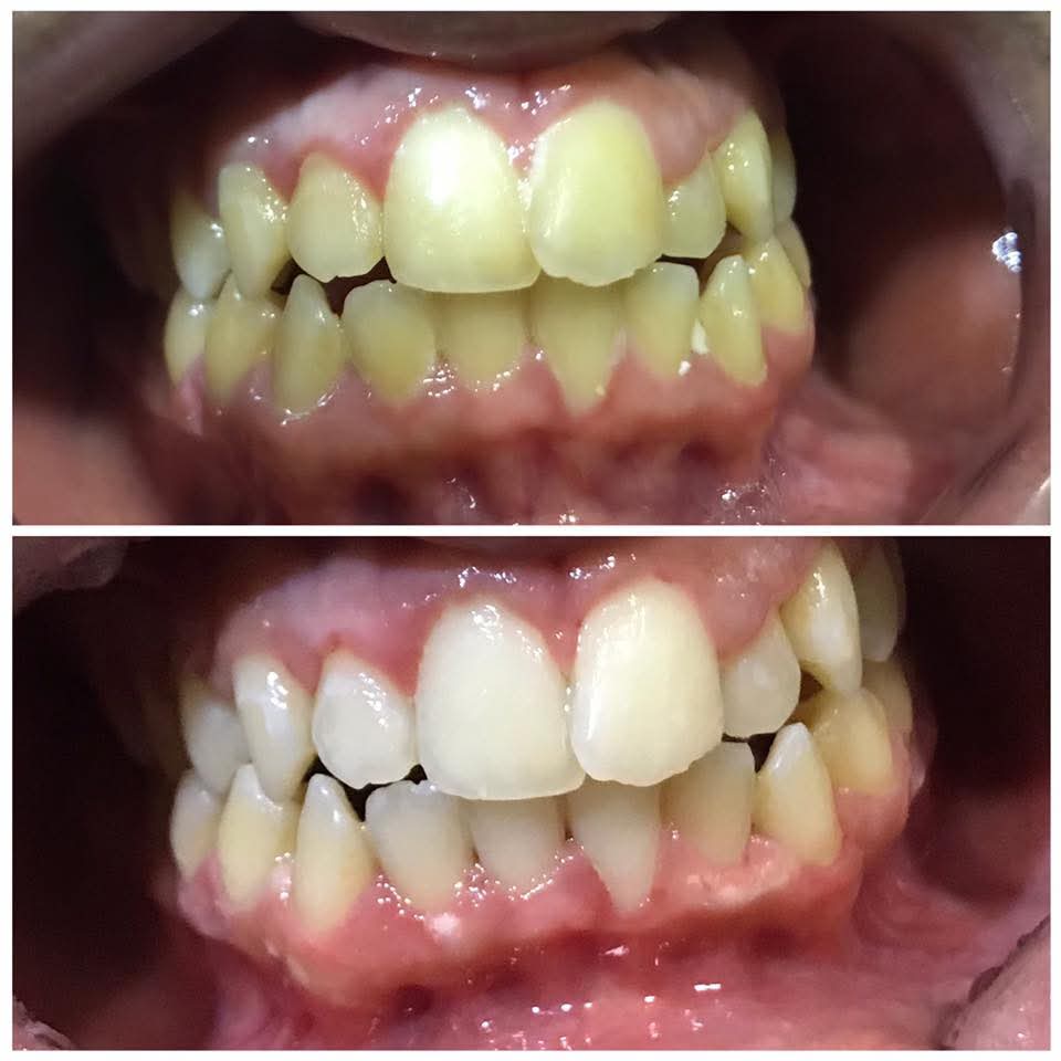 Case 03 — selected dental treatment result